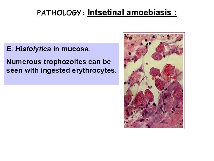 PATHOLOGY: Intsetinal amoebiasis : E. Histolytica in mucosa. Numerous trophozoites can be seen with PATHOLOGY: Intsetinal amoebiasis : E. Histolytica in mucosa. Numerous trophozoites can be seen with