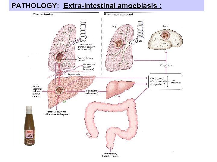 PATHOLOGY: Extra-intestinal amoebiasis : PATHOLOGY: Extra-intestinal amoebiasis :