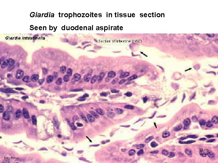 Giardia trophozoites in tissue section Seen by duodenal aspirate Giardia trophozoites in tissue section Seen by duodenal aspirate