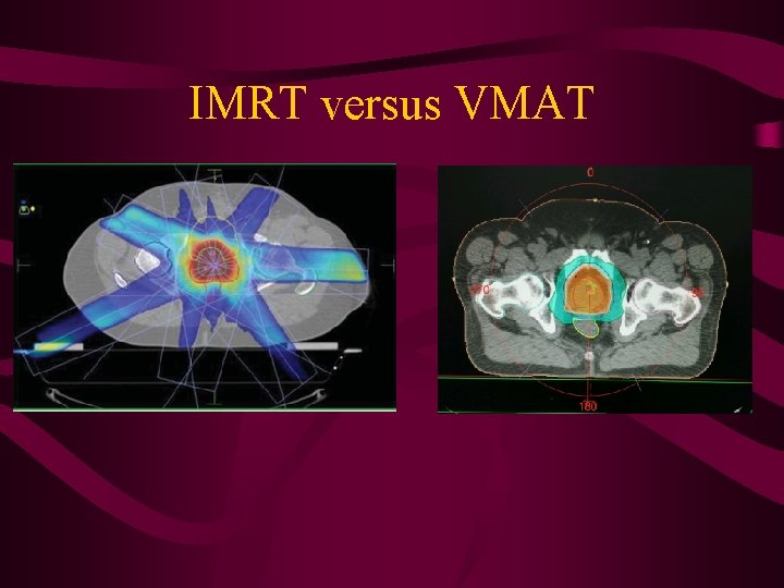 IMRT versus VMAT 