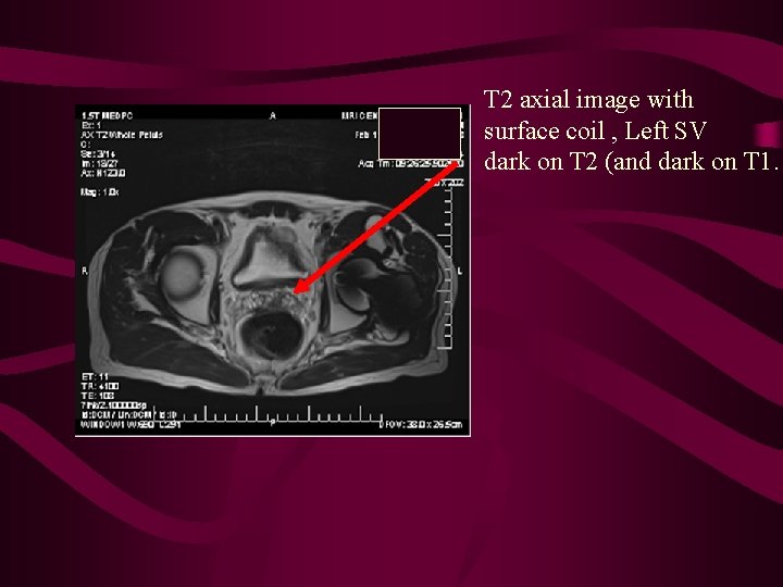 T 2 axial image with surface coil , Left SV dark on T 2