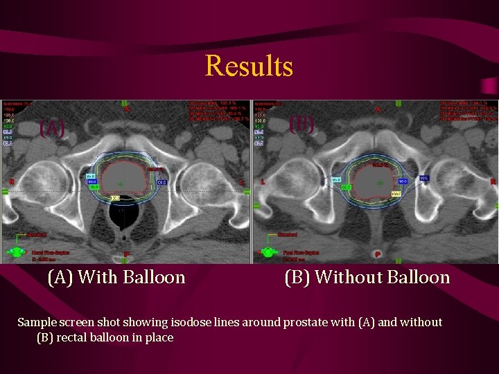 Results (A) With Balloon (B) Without Balloon Sample screen shot showing isodose lines around