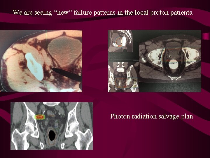 We are seeing “new” failure patterns in the local proton patients. Photon radiation salvage