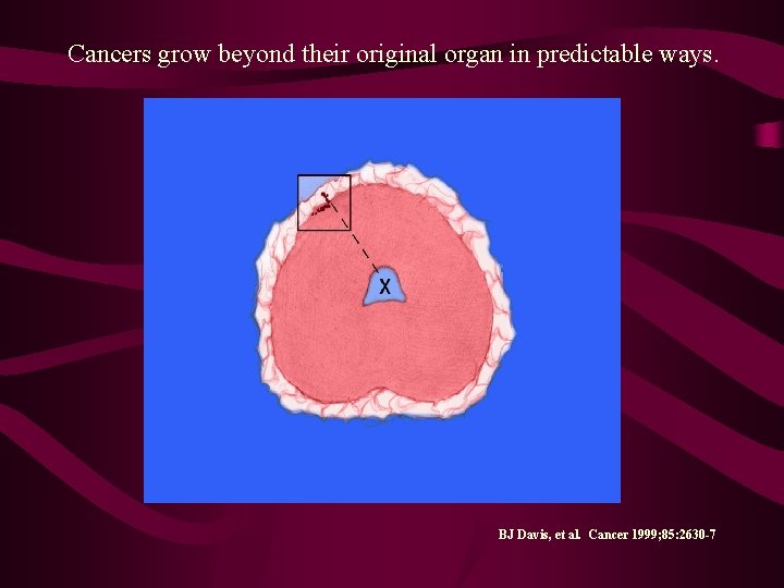 Cancers grow beyond their original organ in predictable ways. BJ Davis, et al. Cancer