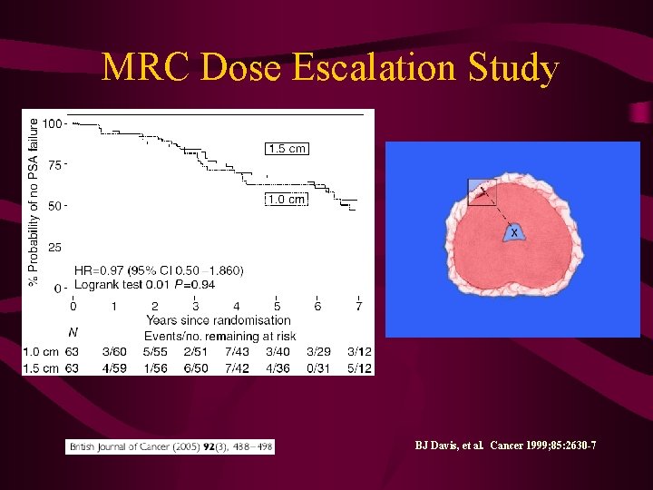 MRC Dose Escalation Study BJ Davis, et al. Cancer 1999; 85: 2630 -7. 