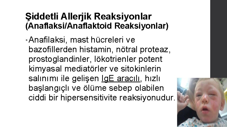 Şiddetli Allerjik Reaksiyonlar (Anaflaksi/Anaflaktoid Reaksiyonlar) • Anafilaksi, mast hücreleri ve bazofillerden histamin, nötral proteaz,