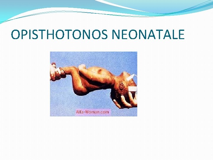 OPISTHOTONOS NEONATALE OPISTHOTONOS NEONATALE