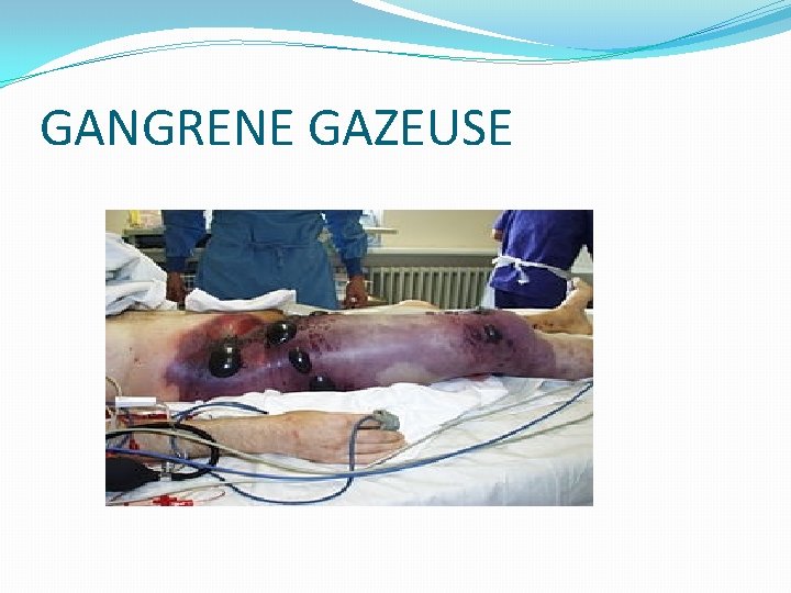 GANGRENE GAZEUSE GANGRENE GAZEUSE