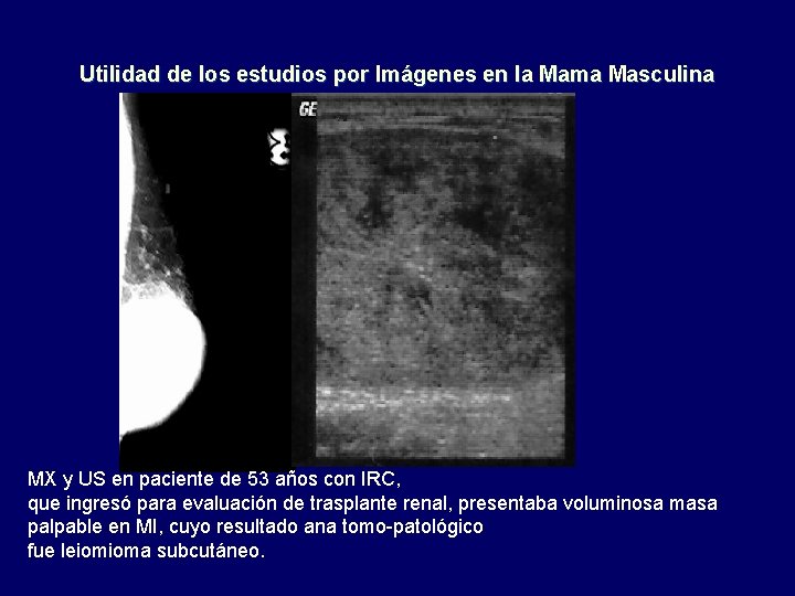 Utilidad de los estudios por Imágenes en la Mama Masculina MX y US en