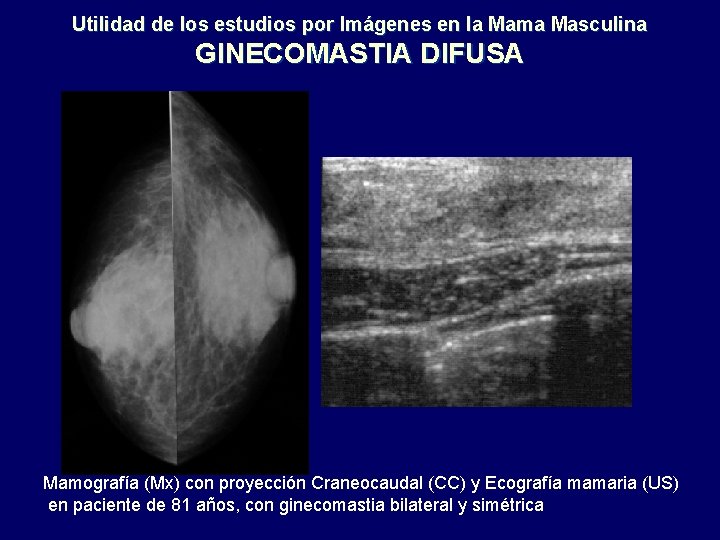 Utilidad de los estudios por Imágenes en la Mama Masculina GINECOMASTIA DIFUSA Mamografía (Mx)