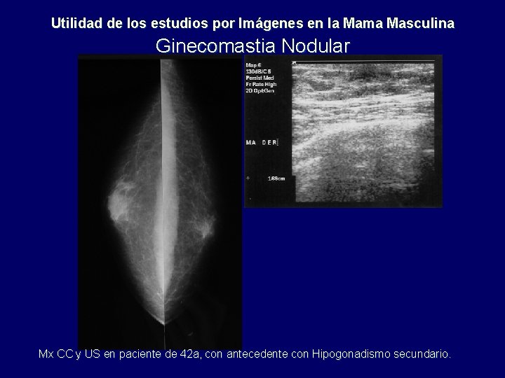 Utilidad de los estudios por Imágenes en la Mama Masculina Ginecomastia Nodular Mx CC