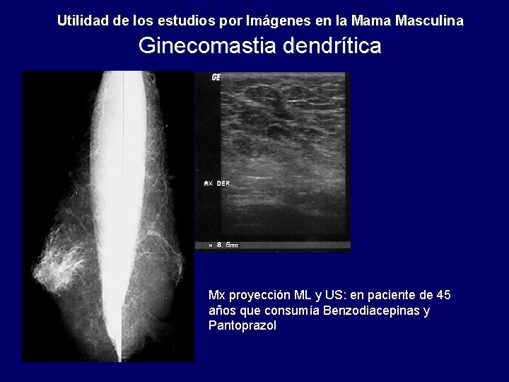 Utilidad de los estudios por Imágenes en la Mama Masculina Ginecomastia dendrítica Mx proyección