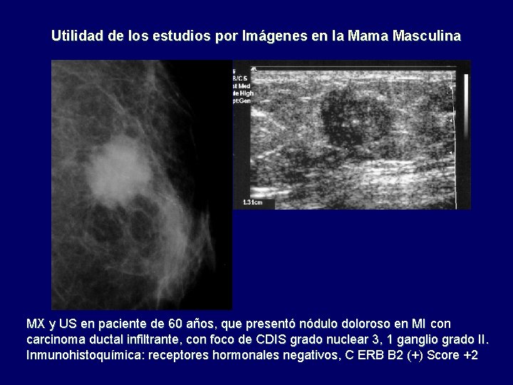 Utilidad de los estudios por Imágenes en la Mama Masculina MX y US en
