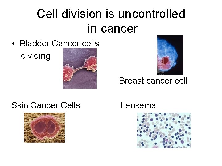 Cell division is uncontrolled in cancer • Bladder Cancer cells dividing Breast cancer cell