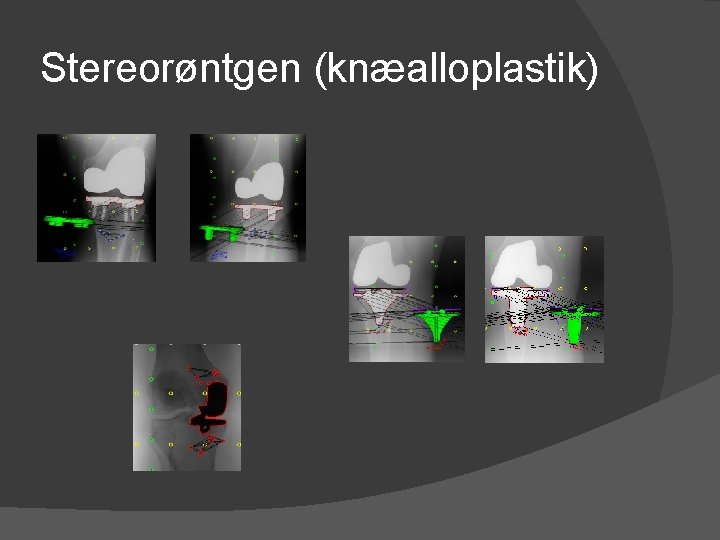 Stereorøntgen (knæalloplastik) 