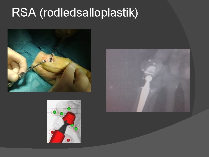 RSA (rodledsalloplastik) 