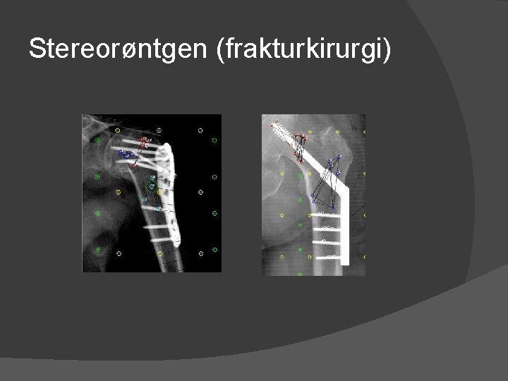 Stereorøntgen (frakturkirurgi) 
