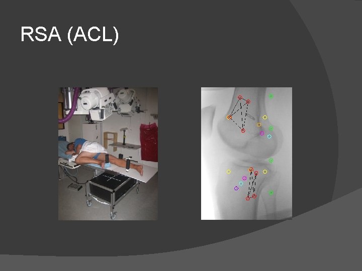 RSA (ACL) 