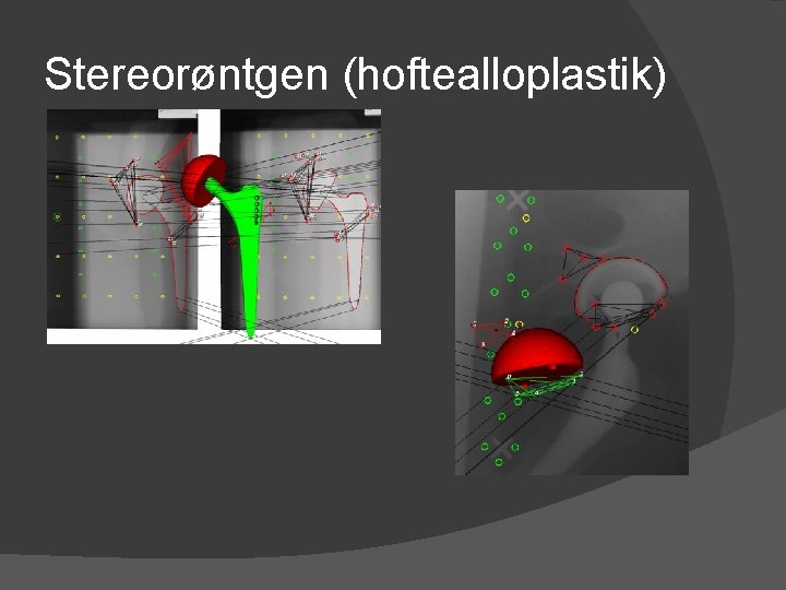 Stereorøntgen (hoftealloplastik) 