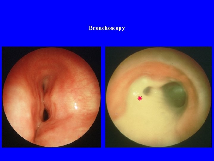 Bronchoscopy 