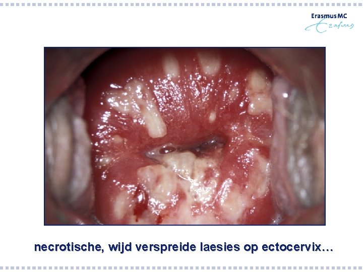 necrotische, wijd verspreide laesies op ectocervix… necrotische, wijd verspreide laesies op ectocervix…