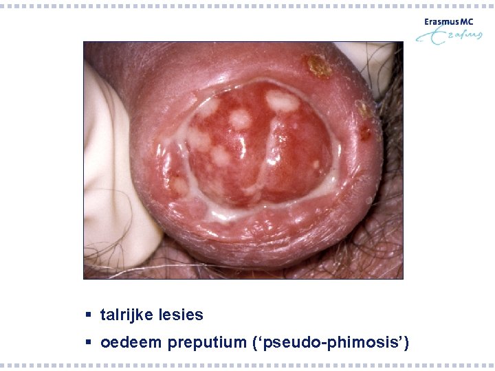 § talrijke lesies § oedeem preputium (‘pseudo-phimosis’) § talrijke lesies § oedeem preputium (‘pseudo-phimosis’)