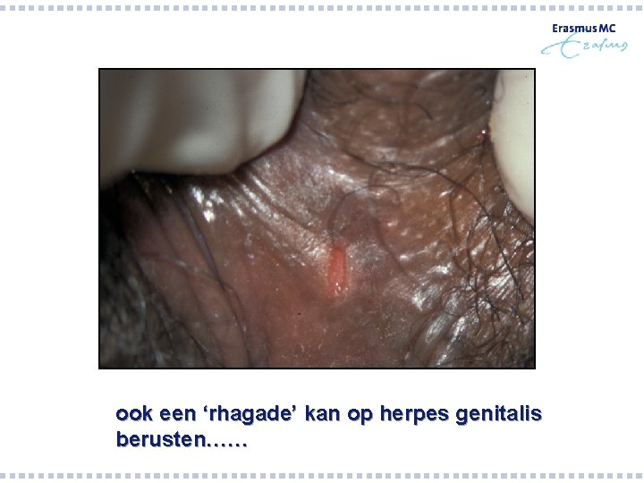 Genitalis herper Genital Herpes