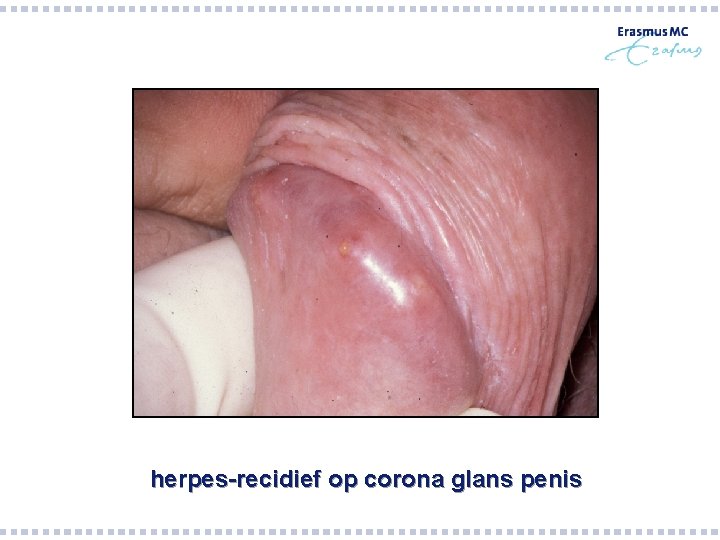 herpes-recidief op corona glans penis herpes-recidief op corona glans penis