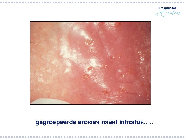 gegroepeerde erosies naast introitus…. . gegroepeerde erosies naast introitus…. .