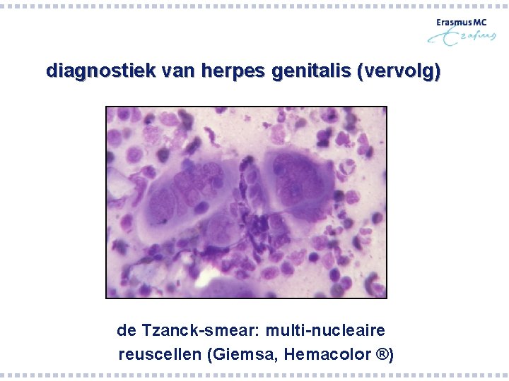diagnostiek van herpes genitalis (vervolg) de Tzanck-smear: multi-nucleaire reuscellen (Giemsa, Hemacolor ®) diagnostiek van herpes genitalis (vervolg) de Tzanck-smear: multi-nucleaire reuscellen (Giemsa, Hemacolor ®)