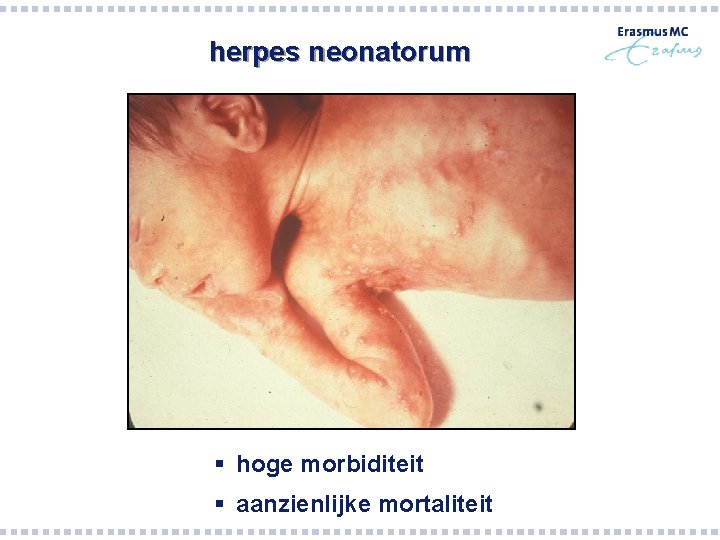 herpes neonatorum § hoge morbiditeit § aanzienlijke mortaliteit herpes neonatorum § hoge morbiditeit § aanzienlijke mortaliteit