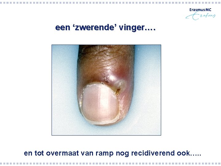 een ‘zwerende’ vinger…. en tot overmaat van ramp nog recidiverend ook…. . een ‘zwerende’ vinger…. en tot overmaat van ramp nog recidiverend ook…. .