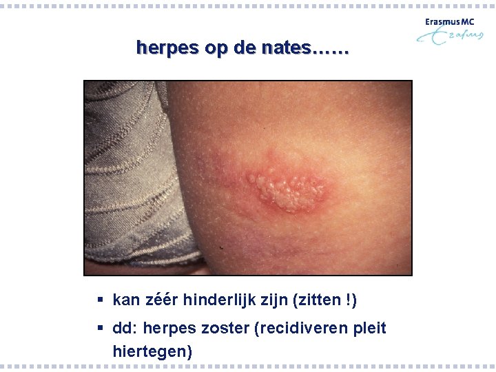 herpes op de nates…… § kan zéér hinderlijk zijn (zitten !) § dd: herpes herpes op de nates…… § kan zéér hinderlijk zijn (zitten !) § dd: herpes