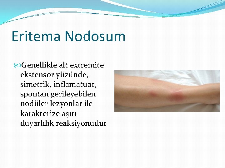 Eritema Nodosum Genellikle alt extremite ekstensor yüzünde, simetrik, inflamatuar, spontan gerileyebilen nodüler lezyonlar ile