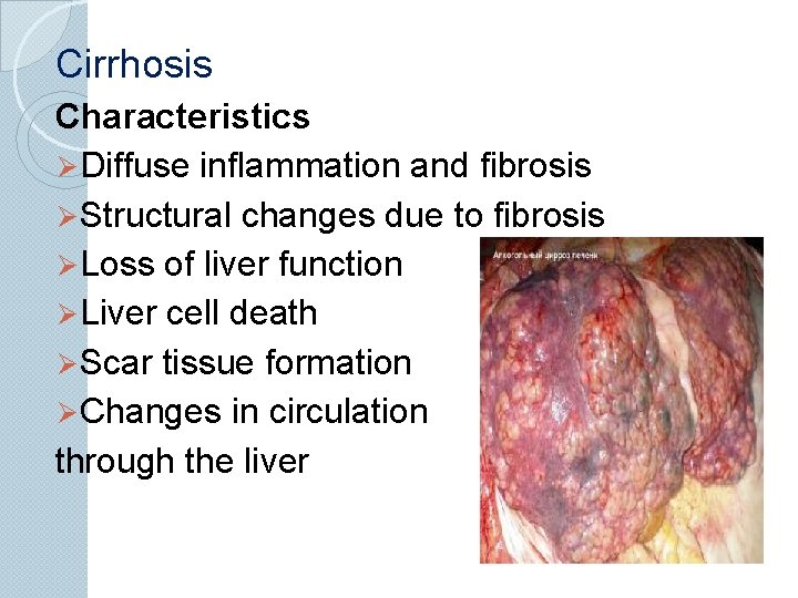 Cirrhosis Characteristics Ø Diffuse inflammation and fibrosis Ø Structural changes due to fibrosis Ø