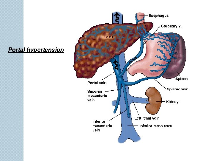 Portal hypertension 