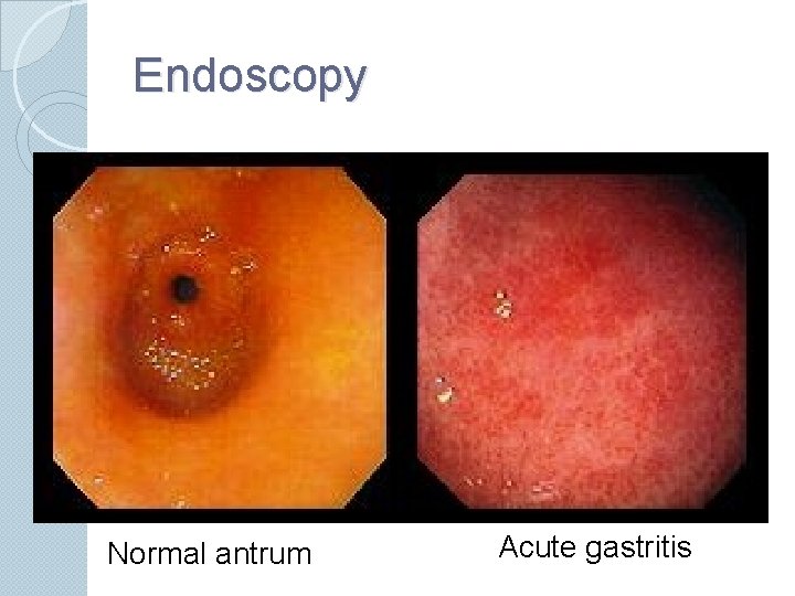 Endoscopy Normal antrum Acute gastritis 