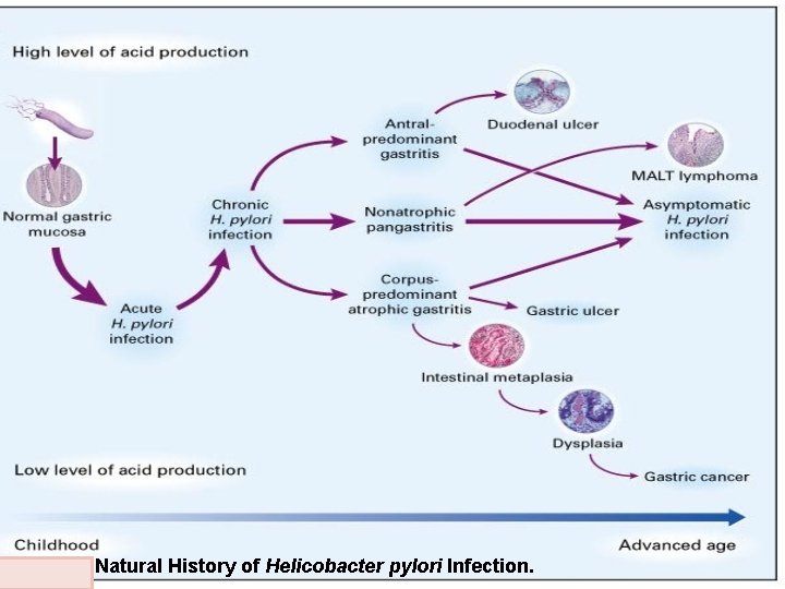 Figure 3. Natural History of Helicobacter pylori Infection. 