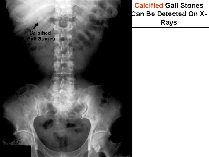 Calcified Gall Stones Can Be Detected On XRays 