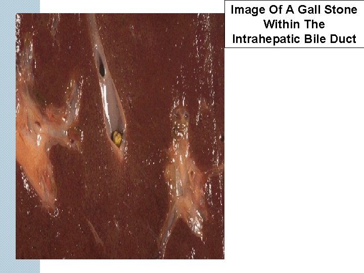 Image Of A Gall Stone Within The Intrahepatic Bile Duct 