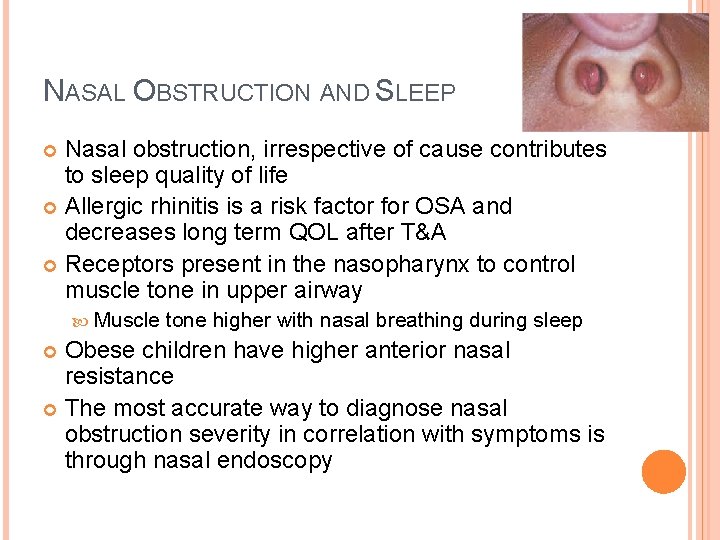 NASAL OBSTRUCTION AND SLEEP Nasal obstruction, irrespective of cause contributes to sleep quality of NASAL OBSTRUCTION AND SLEEP Nasal obstruction, irrespective of cause contributes to sleep quality of