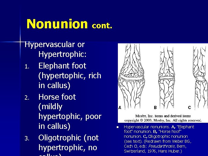Nonunion cont. Hypervascular or Hypertrophic: 1. Elephant foot (hypertophic, rich in callus) 2. Horse