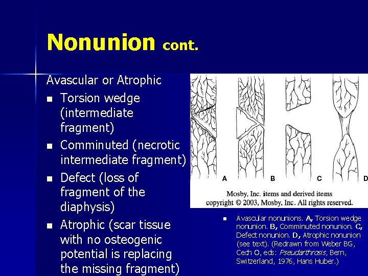 Nonunion cont. Avascular or Atrophic n Torsion wedge (intermediate fragment) n Comminuted (necrotic intermediate
