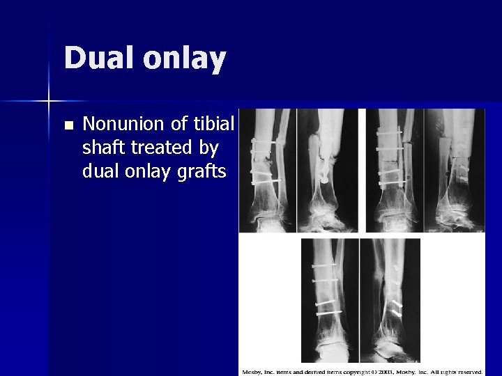 Dual onlay n Nonunion of tibial shaft treated by dual onlay grafts 
