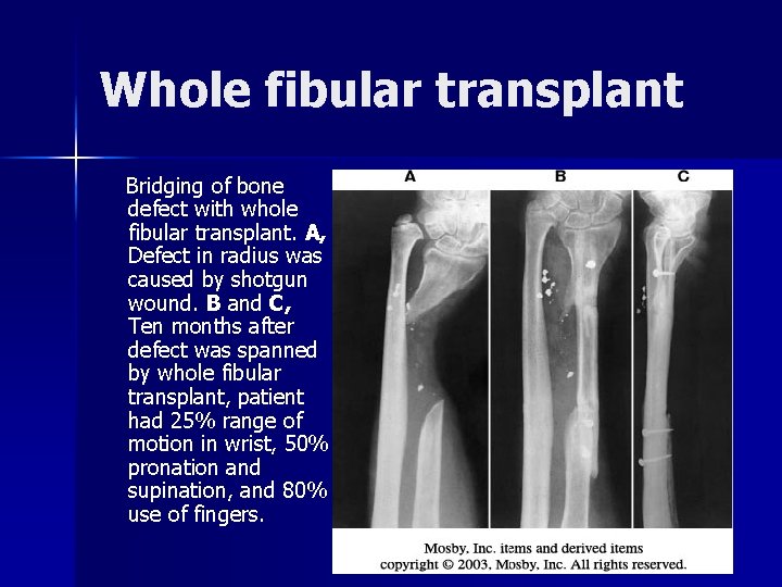 Whole fibular transplant Bridging of bone defect with whole fibular transplant. A, Defect in
