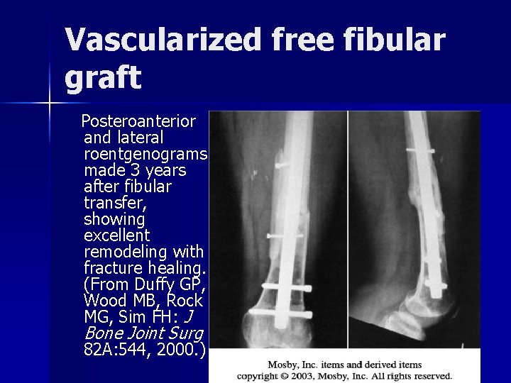 Vascularized free fibular graft Posteroanterior and lateral roentgenograms made 3 years after fibular transfer,