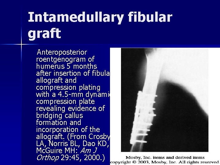 Intamedullary fibular graft Anteroposterior roentgenogram of humerus 5 months after insertion of fibular allograft