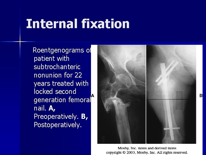 Internal fixation Roentgenograms of patient with subtrochanteric nonunion for 22 years treated with locked