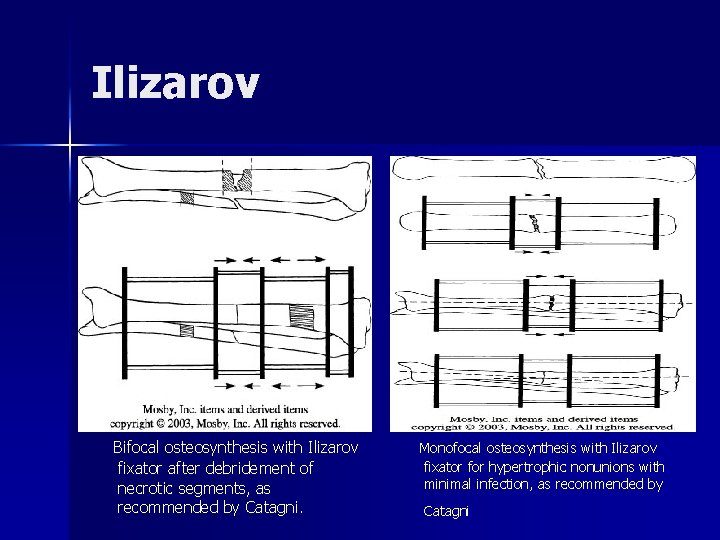 Ilizarov Bifocal osteosynthesis with Ilizarov fixator after debridement of necrotic segments, as recommended by