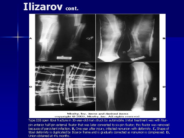 Ilizarov cont. Type IIIB open tibial fracture in 30 -year-old man struck by automobile.